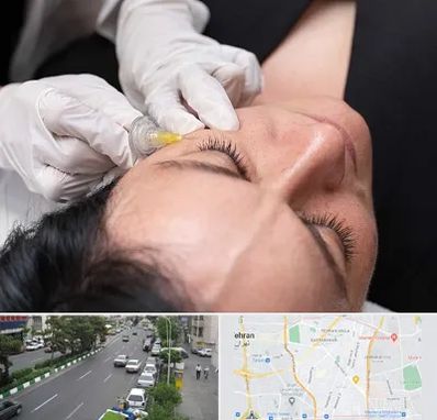 کربوکسی تراپی در ستارخان 