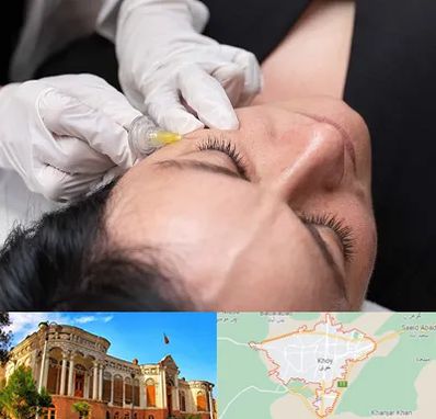 کربوکسی تراپی در خوی