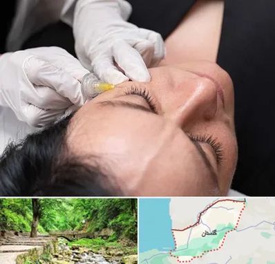 کربوکسی تراپی در گلستان