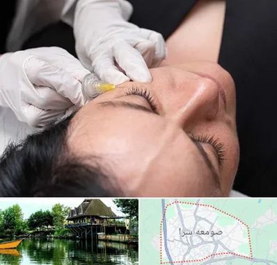 کربوکسی تراپی در صومعه سرا