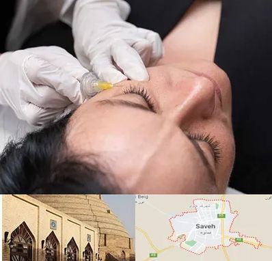 کربوکسی تراپی در ساوه