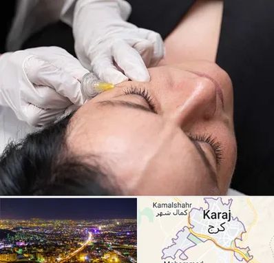 کربوکسی تراپی در کرج