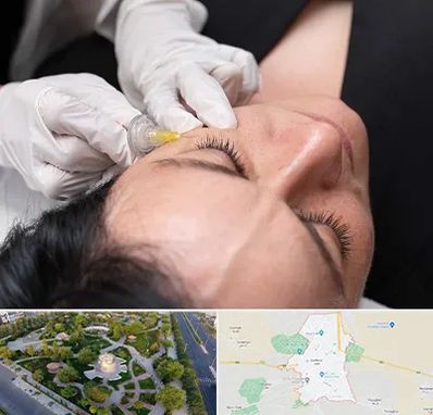 کربوکسی تراپی در کاشمر