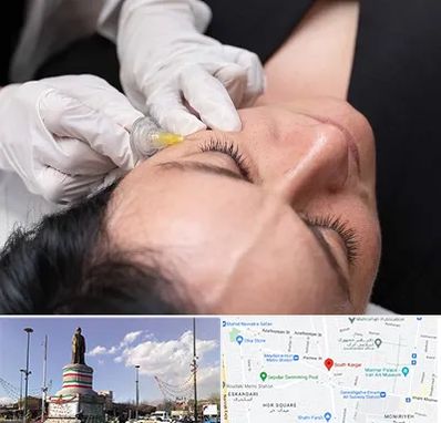 کربوکسی تراپی در کارگر جنوبی 