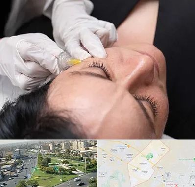 کربوکسی تراپی در کمال شهر کرج 