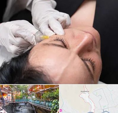 کربوکسی تراپی در درکه