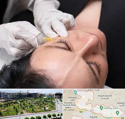 کربوکسی تراپی در پردیس