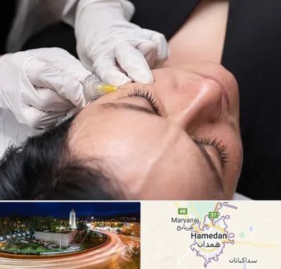 کربوکسی تراپی در همدان