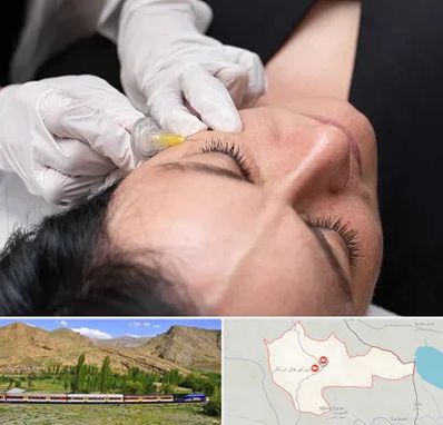 کربوکسی تراپی در خاش