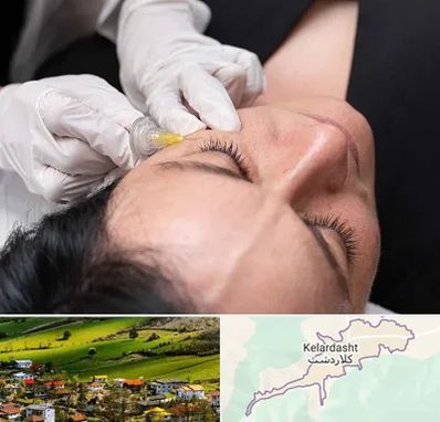 کربوکسی تراپی در کلاردشت