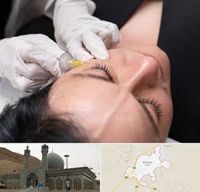 کربوکسی تراپی در شهرضا