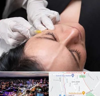 کربوکسی تراپی در گلسار رشت 