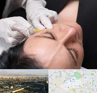 کربوکسی تراپی در منطقه 19 تهران 