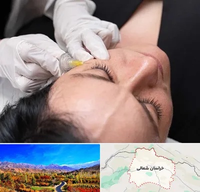 کربوکسی تراپی در خراسان شمالی