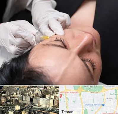 کربوکسی تراپی در مرزداران 