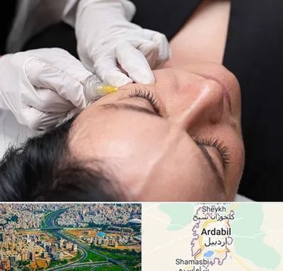 کربوکسی تراپی در اردبیل