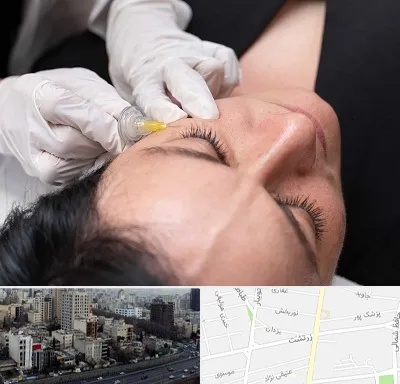 کربوکسی تراپی در زرتشت