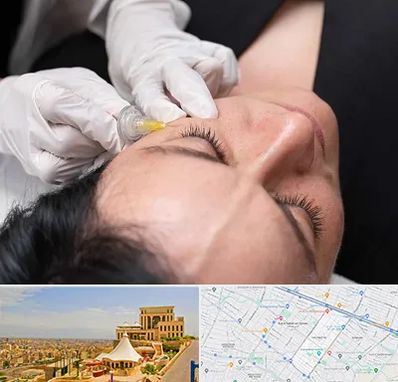 کربوکسی تراپی در هاشمیه مشهد