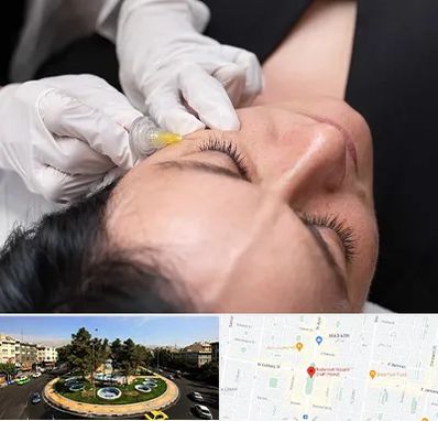 کربوکسی تراپی در هفت حوض 