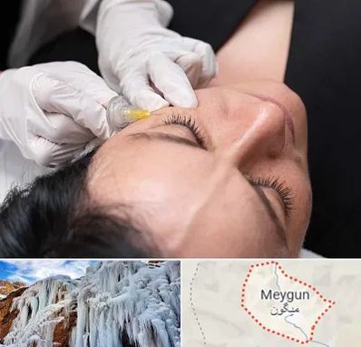 کربوکسی تراپی در میگون
