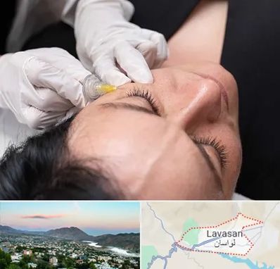 کربوکسی تراپی در لواسان