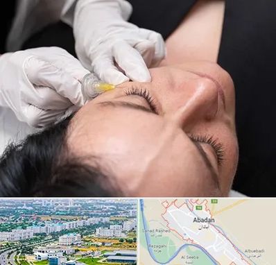 کربوکسی تراپی در آبادان