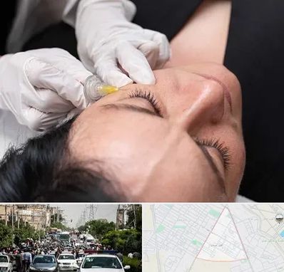 کربوکسی تراپی در سیدی مشهد