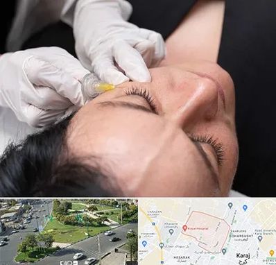 کربوکسی تراپی در شاهین ویلا کرج