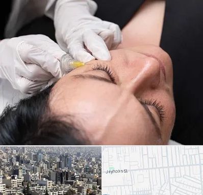 کربوکسی تراپی در جیحون