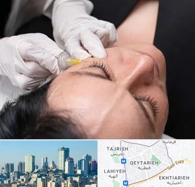 کربوکسی تراپی در قیطریه 