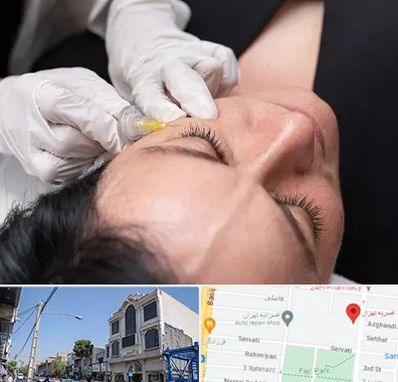 کربوکسی تراپی در افسریه 