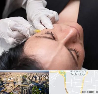 کربوکسی تراپی در استاد معین 