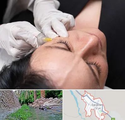 کربوکسی تراپی در سراوان