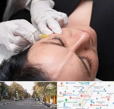 کربوکسی تراپی در شریعتی 