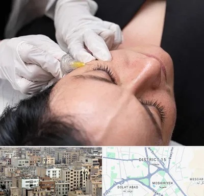 کربوکسی تراپی در جنوب شرق تهران
