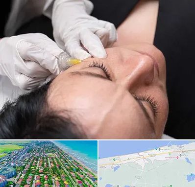 کربوکسی تراپی در فریدونکنار