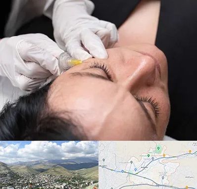 کربوکسی تراپی در رودهن