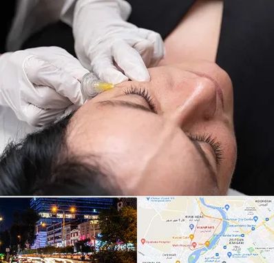 کربوکسی تراپی در کیانپارس اهواز