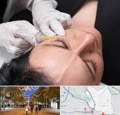 کربوکسی تراپی در ولیعصر ارومیه