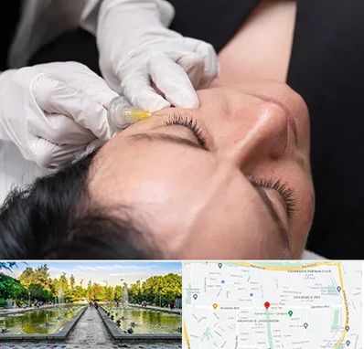 کربوکسی تراپی در سرسبز 