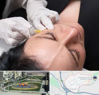 کربوکسی تراپی در مرزداران تبریز