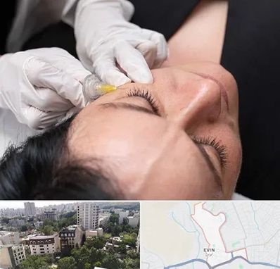 کربوکسی تراپی در اوین