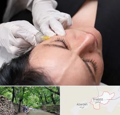 کربوکسی تراپی در شاندیز مشهد