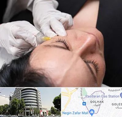 کربوکسی تراپی در قلهک 