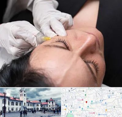 کربوکسی تراپی در میدان شهرداری رشت