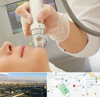 آر اف فرکشنال در هنگام 