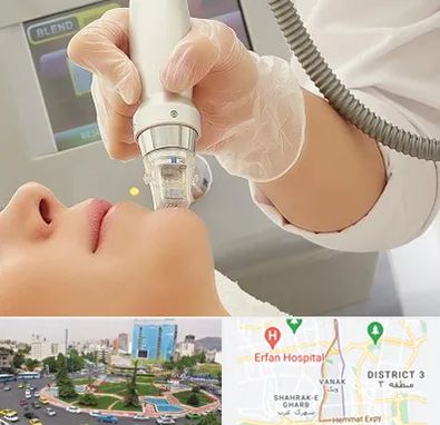 آر اف فرکشنال در ونک 