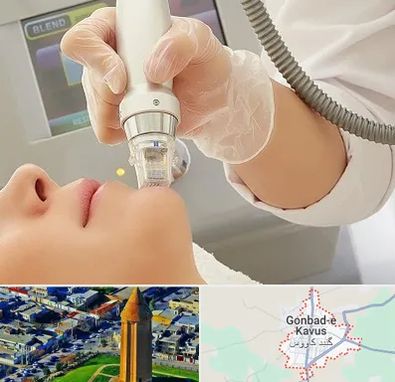 آر اف فرکشنال در گنبد کاووس