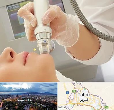 آر اف فرکشنال در تبریز