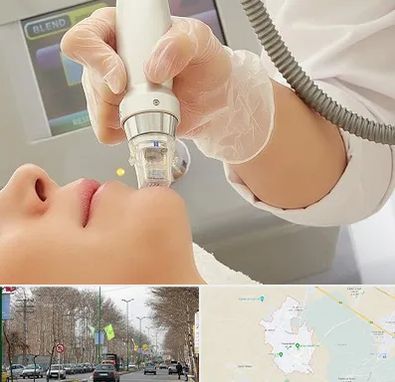 آر اف فرکشنال در نظرآباد کرج 